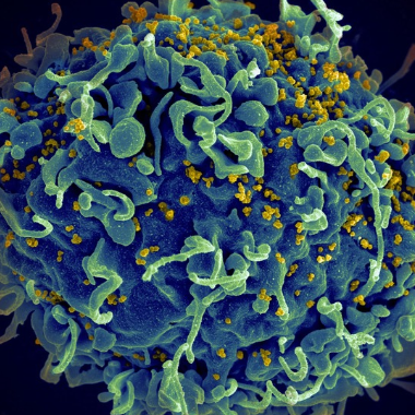 A human T cell under attack by HIV viruses 